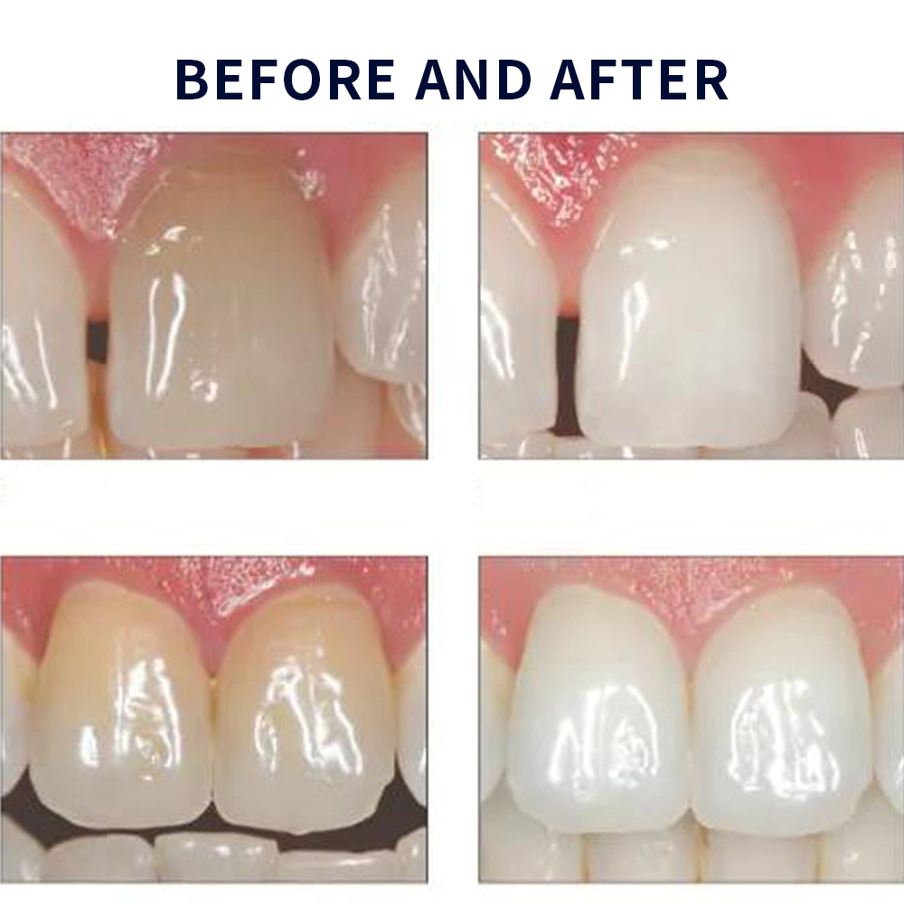 Opalescentie Whitening 20% Pf  - Teeth Whitening With Peroxide recensie en prijs