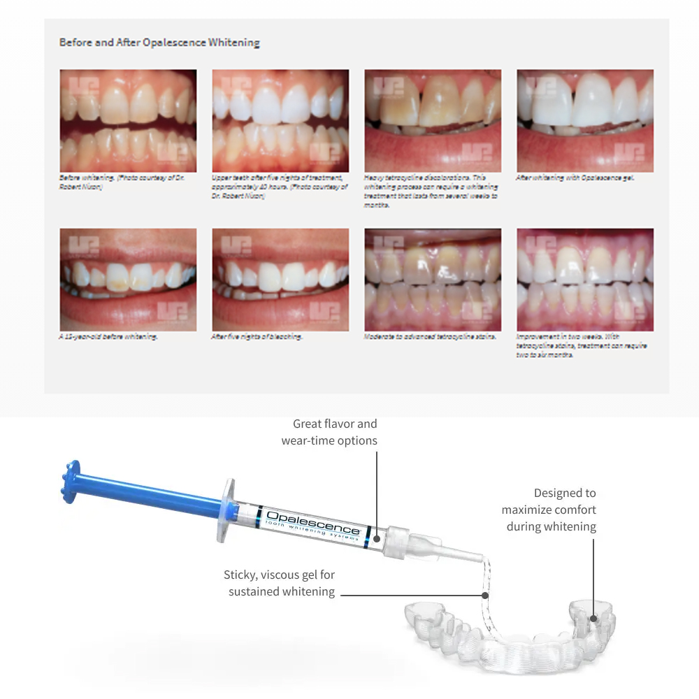 Opalescentie Whitening 20% Pf  - Teeth Whitening With Peroxide recensie en prijs