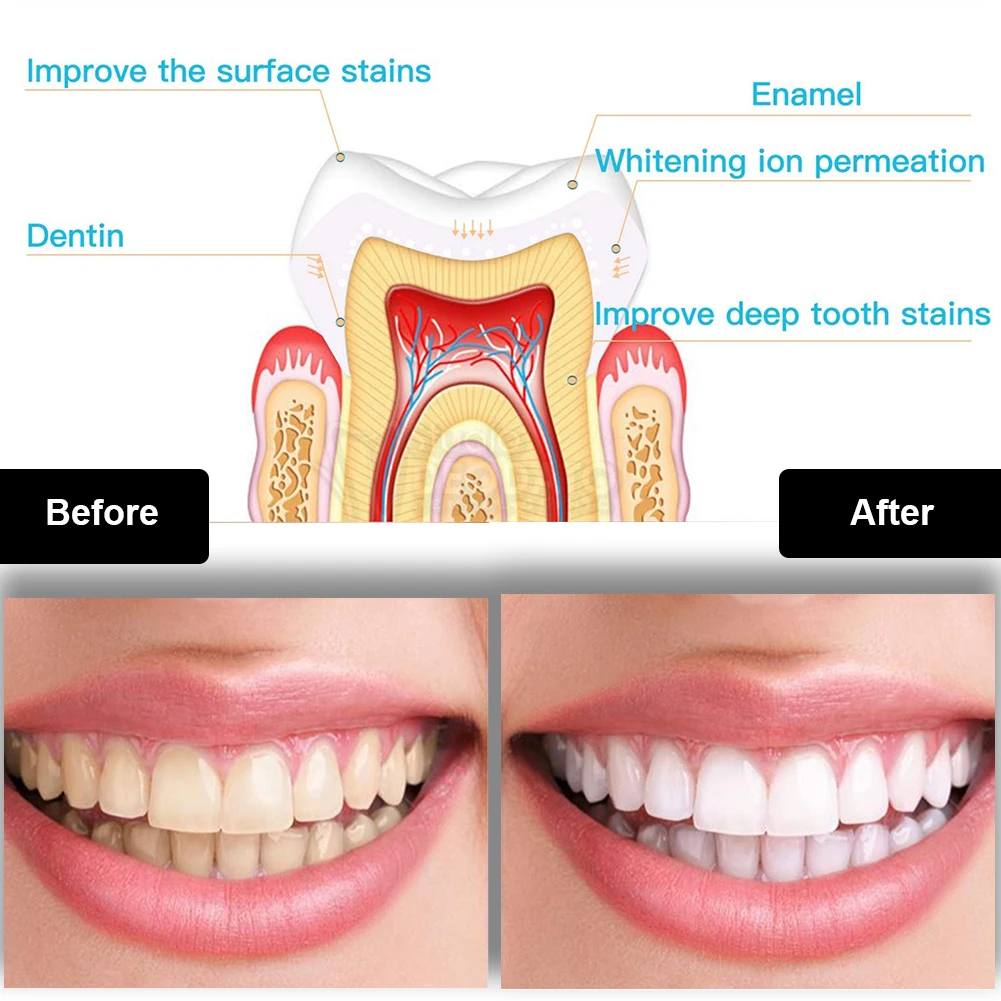 Tandheelkundige Tanden Whiteni - Teeth Whitening Led Kit recensie en prijs